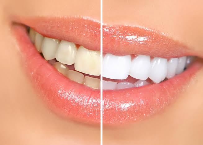Clareamento dental no consultório da Dra. Roberta Terme em Canoas