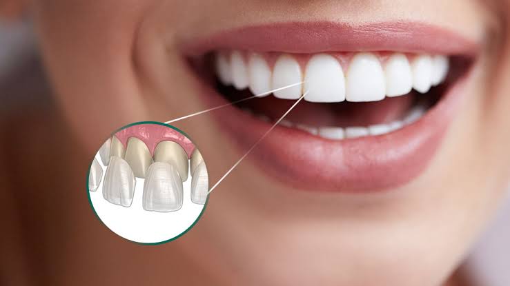 Lentes de contato dental em Canoas