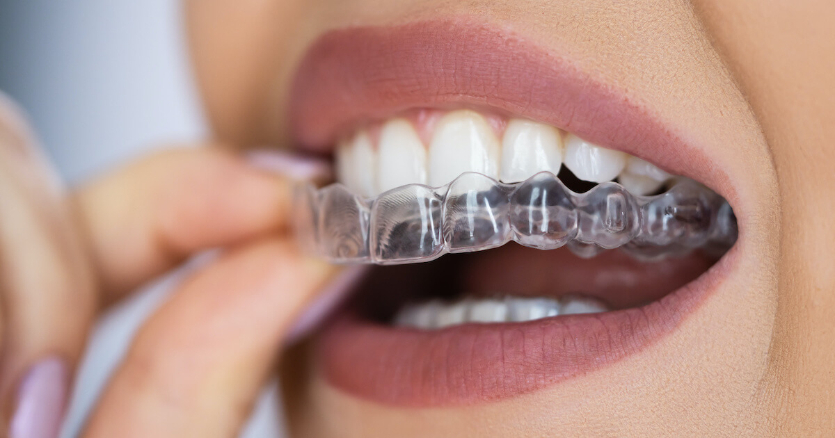 Invisalign com dentista em Canoas, RS